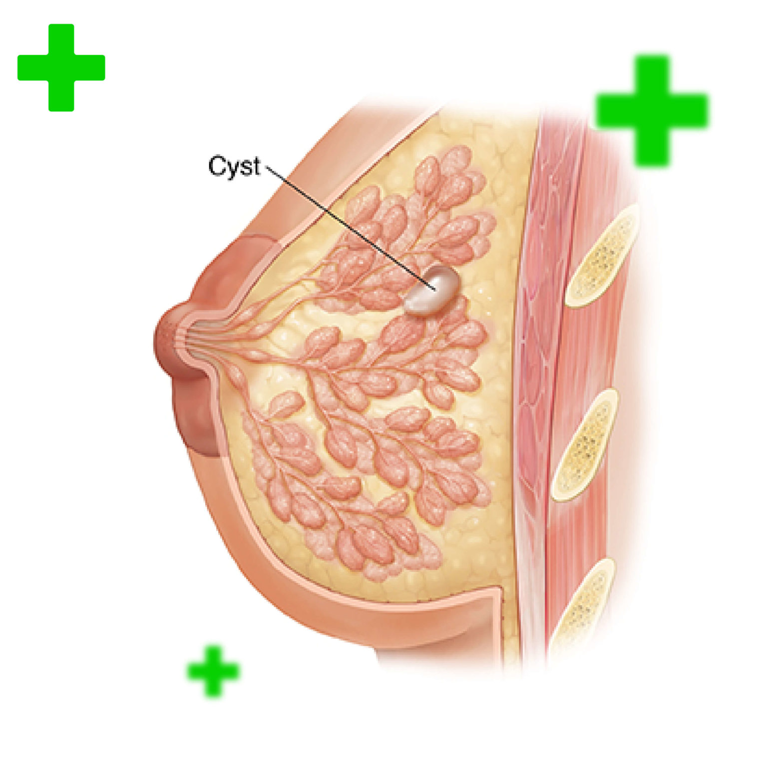 cyst