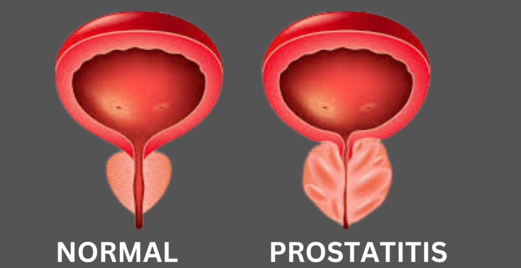 Chronic Prostatitis